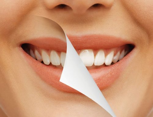 بلیچینگ دندان چیست؟ انواع روش های سفید کردن دندان