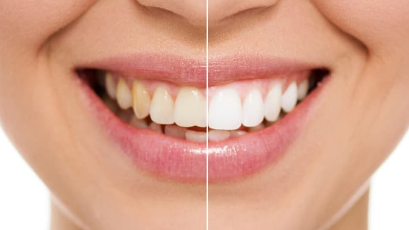 بلیچینگ دندان چیست؟