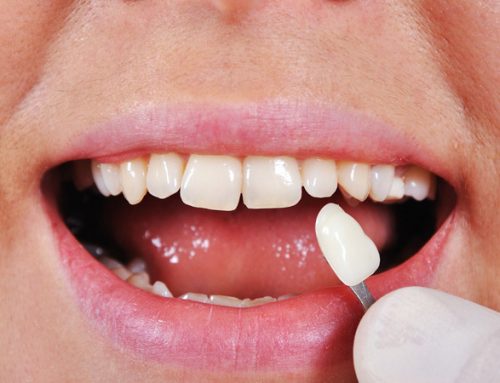 روکش دندان چیست؟ انواع روکش دندان و هر آنچه لازم است در مورد آن بدانید