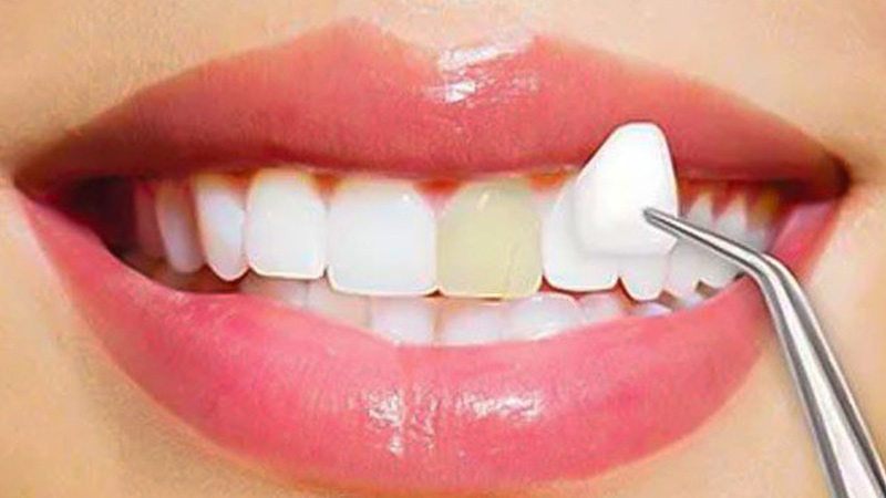 روکش دندان چیست؟