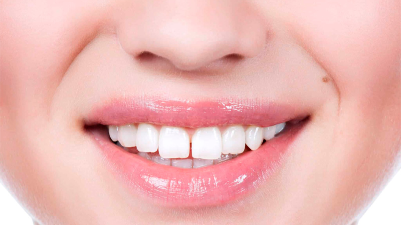 درمان فاصله بین دندان ها