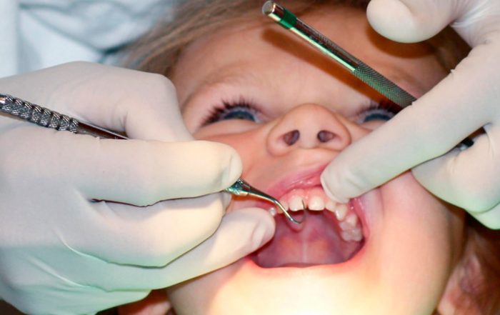 درمان پوسیدگی دندان کودکان